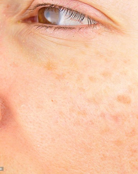 ultralase pigmentation removal