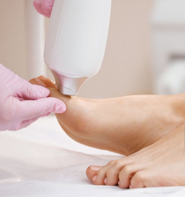 ultralase saltney chester fungal nail