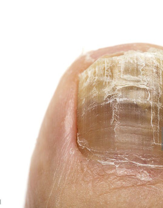 ultralase saltney chester fungal nai