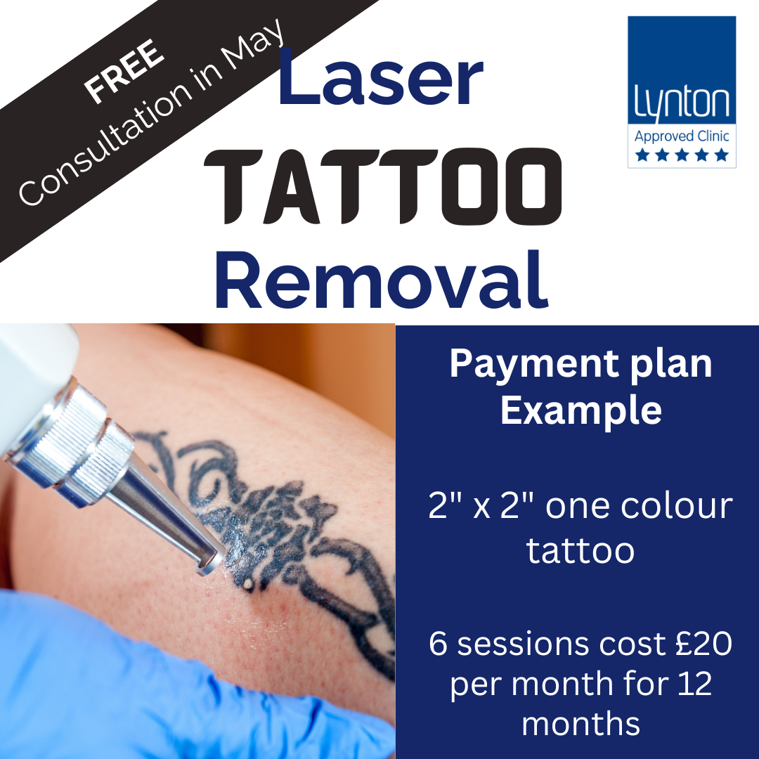 Ultralase laser tattoo removal saltney chester