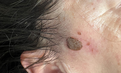 Kerrotisis-removal-saltney-chester